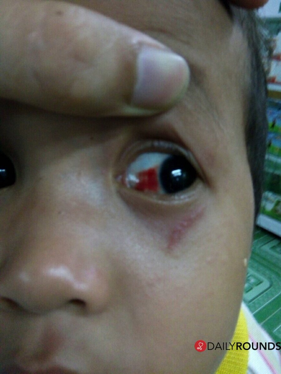 marrow_med's tweet photo. #subconjunctival hemorrhage. https://t.co/w6nPTNRdgO