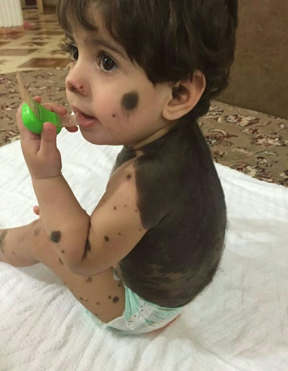 HashKSA's tweet photo. #حالة_إنسانية: الطفلة "الين فيصل العنزي" مصابة بمرض الشامة العملاقة، ووالدها يناشد أهل الخير لمساعدته في علاجها. https://t.co/gRtBtZpkIq