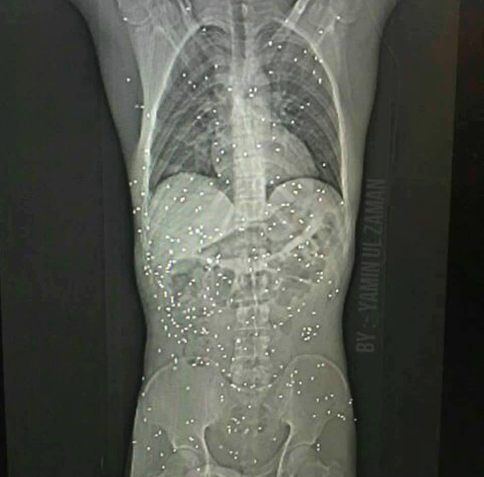 SalmanAWrites's tweet photo. An x ray of a Kashmir boy hit by pellets...This evil weapon meant for beasts should be banned.

#Kashmir #India https://t.co/8DFhPj0kJx