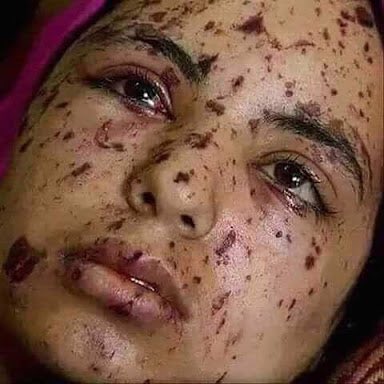 Sohaib547's tweet photo. It has not happened anywhere in the world,102 people have been hit in the eye by pellet used by Indian forces #India https://t.co/Z7Yd1RzZEY