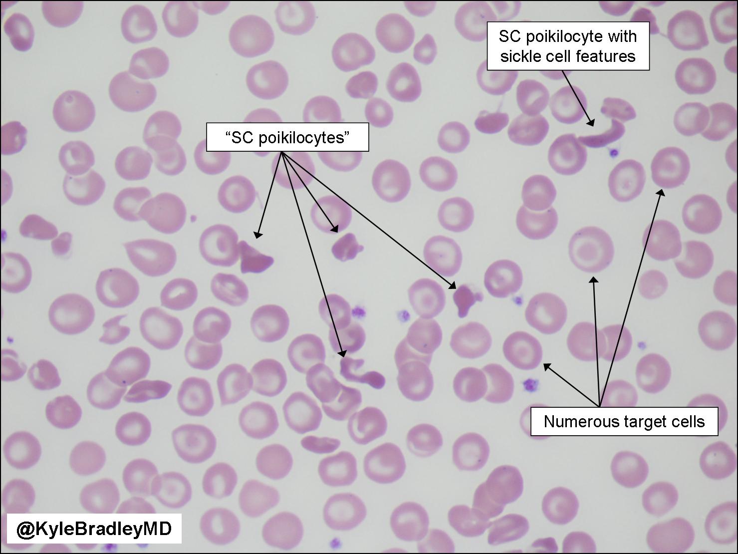 Hemoglobin Sc Disease Blood Smear hemoglobin-sc-disease-blood-smear