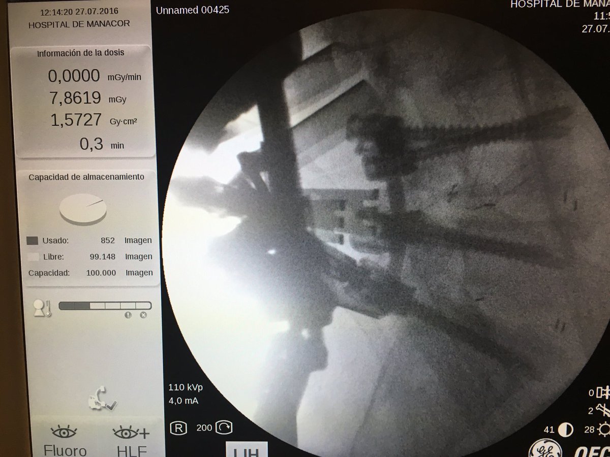corralmunar's tweet photo. #TLIF #Spine #Lumbar #Transforaminal #interbody #fusion #lowback #Pain #sciatica #bonegraf https://t.co/aTNKGmuhed