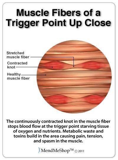 PNMTAZ2015's tweet photo. A trigger point up close #PrecisionMassage #massagetherapy #triggerpoint #PeoriaAZ https://t.co/NowyhK70Kh