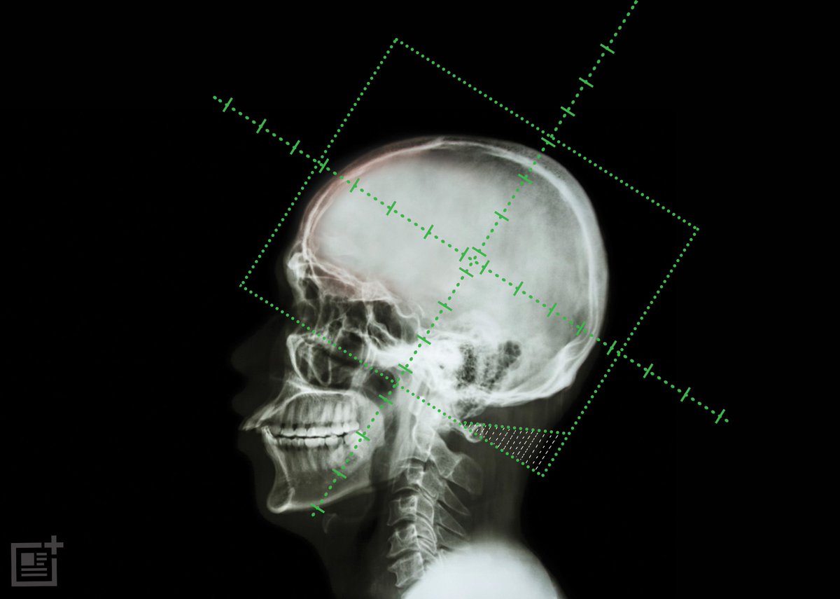 linasusan2's tweet photo. Whole Brain Radiotherapy Should Be Banned For Cancer Patients https://t.co/T3COuRiRWV https://t.co/uULYQb4HXo
