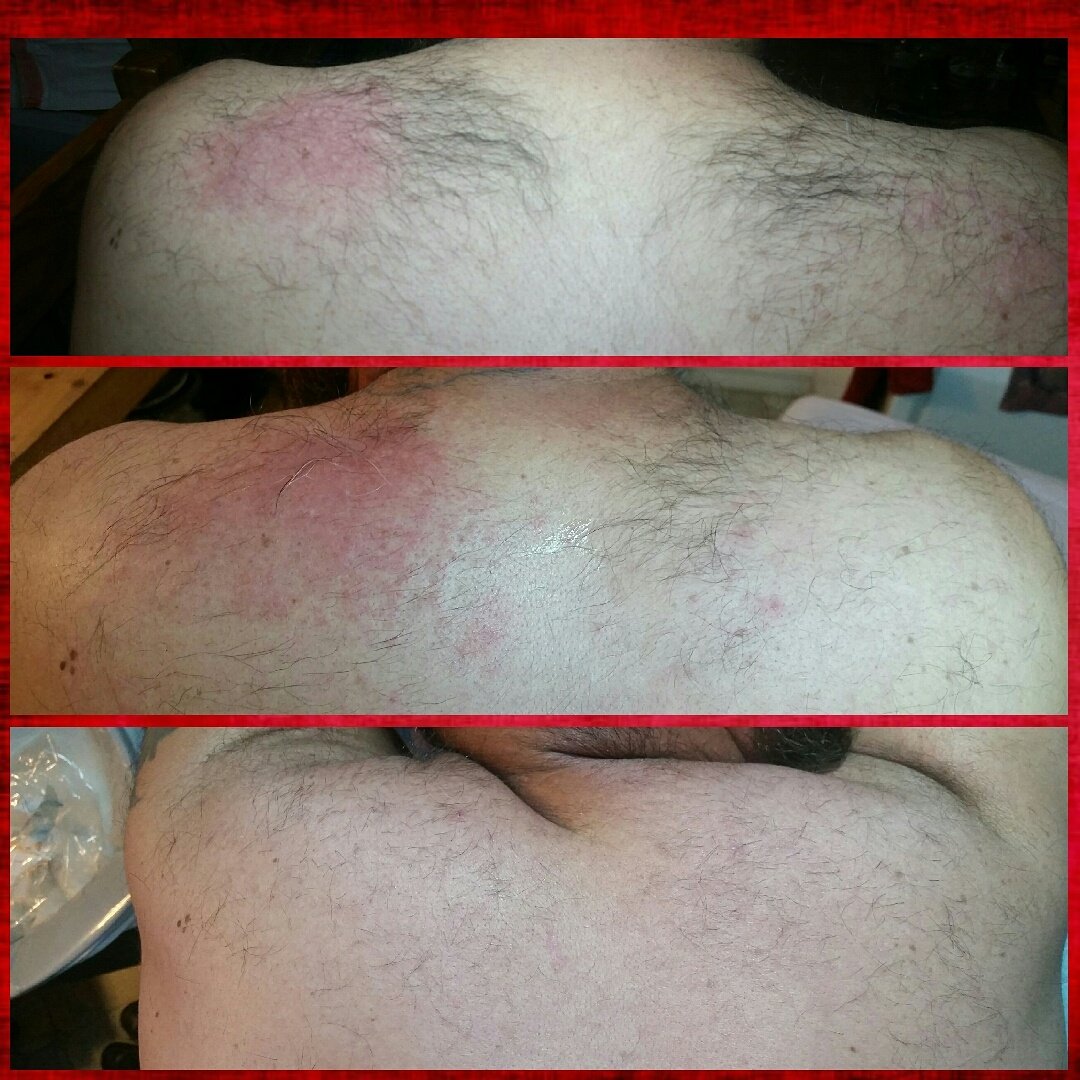 studioemurrieta's tweet photo. Before and after #permanenthairremoval #studioemurrieta #electrology #electrolysis #murrieta #Temecula #hairremoval https://t.co/nqhYqt1LgE