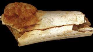 Cancer found in ancient human ancestor's foot ift.tt/2ag4YBM
