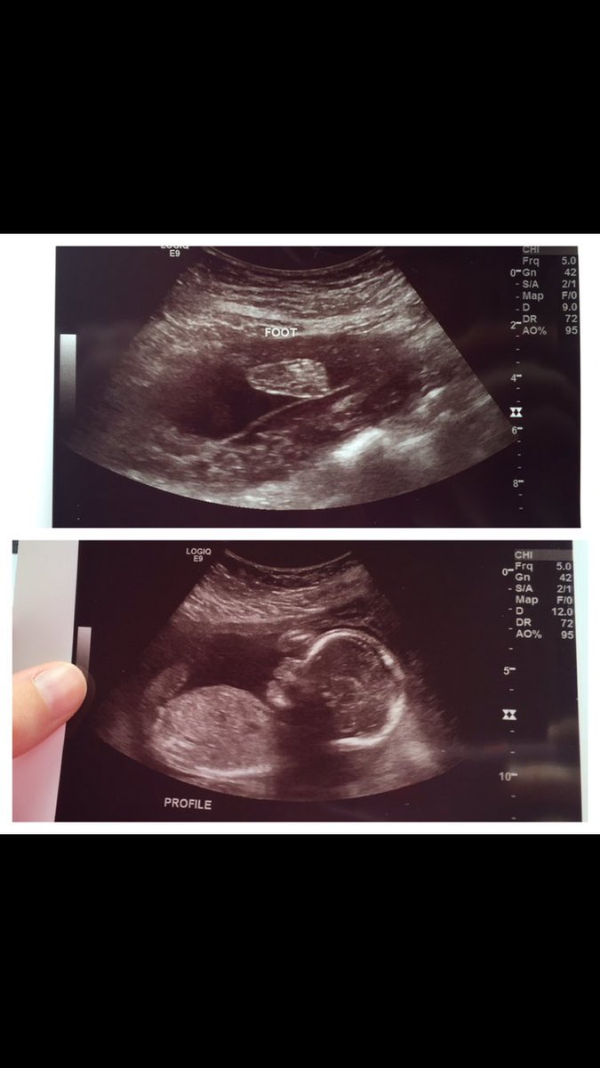 Courtney4aker's tweet photo. Our precious little girl ๐ #babyhunt https://t.co/6jM4ysXvhU