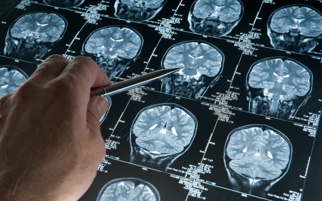 Neuroscientist Shows What Fasting Does To Your Brain &amp; Why Big Pharma Won’t Study It buff.ly/2aqBeVX