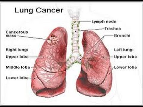 drpramojjindal.com/what-is-lung-c…

Sir #Ganga Ram Hospital #Treatemeht for #Lung Cancer