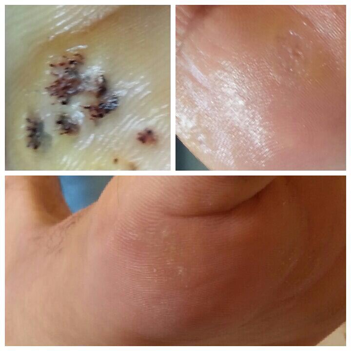 "Ayak Siğilleri" 2 seans sonrası.