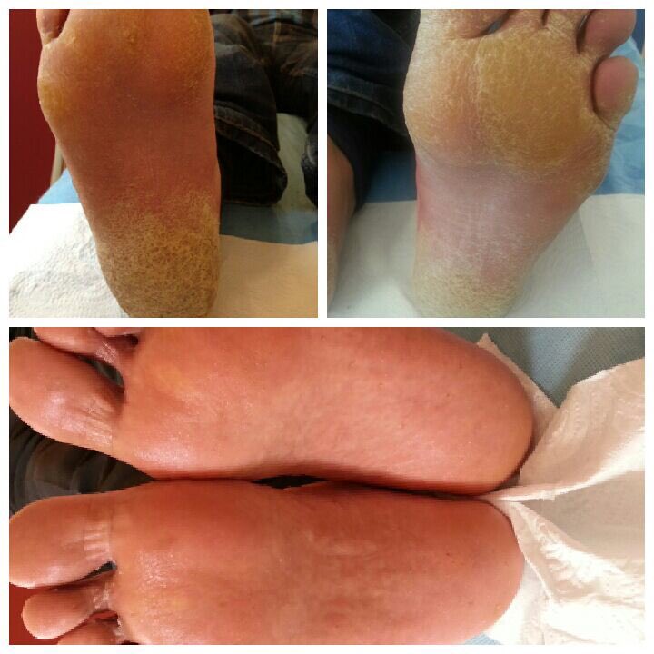 "Ayak Tabanı Kalınlaşmaları" seans sonrası görünümü.