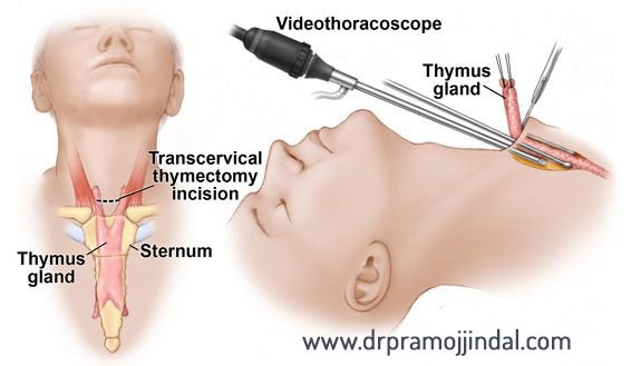 drpramojjindal.com/introduction.h…

#Drpramojjindal for #Myasthenia Gravis and #Thymectomy