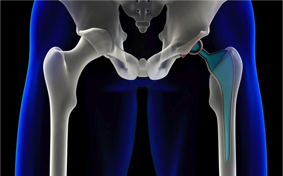 druginjuryatty's tweet photo. DePuy ASR #HipReplacements: the dangers, harm, and recall details: https://t.co/JmZ1J4MWpn #DefectiveDevices https://t.co/b9MPWHbFLH