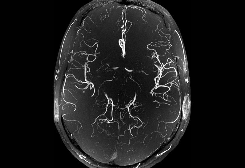 ClevelandClinic's tweet photo. This magnetic resonance angiography – a type of MRI that looks at blood vessels – shows a healthy brain. https://t.co/zi17qD3m6a