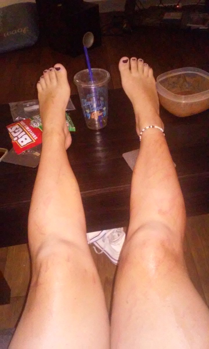 Monicasisson16's tweet photo. So today's adventure meant getting lost barefoot walking through hobo camps๐ญ๐ #watchforcrackpipes. #scratchedup https://t.co/49eamWsPQT
