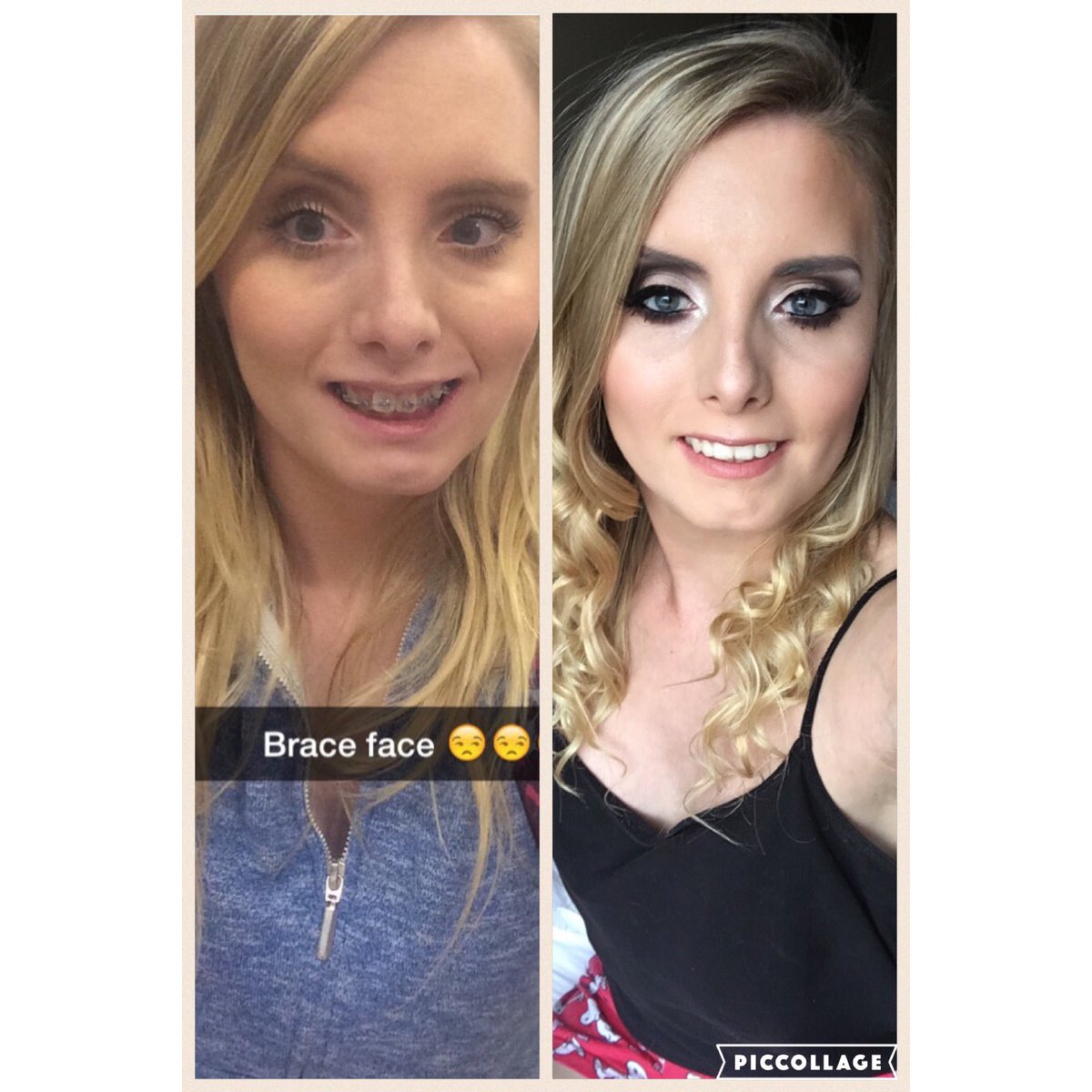 alongcamebecs_'s tweet photo. What a transformation 💛 #braces https://t.co/iooWd8pVil