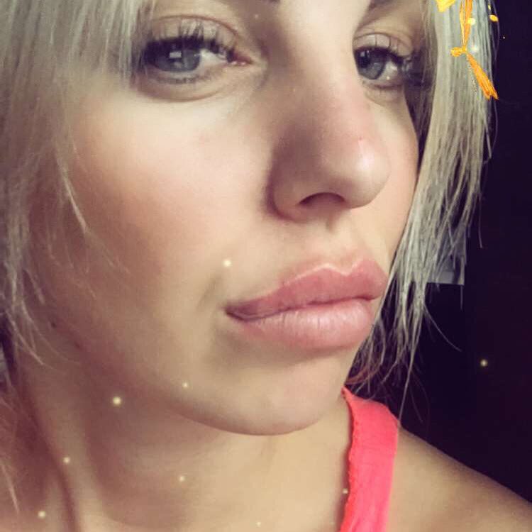 leafarrell's tweet image. New lips 💉💉