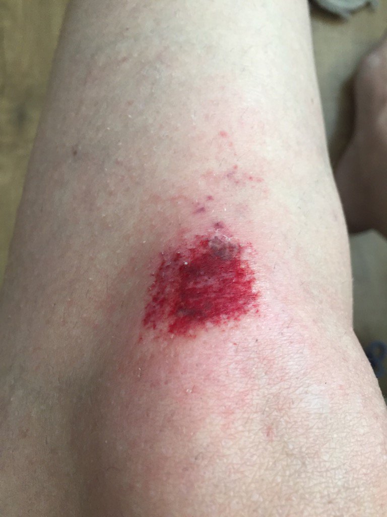 mandajstevens's tweet photo. Thanks @PokemonGoApp for grazed knee, and cracked screen, and all I got was a bloody Eevee from my egg. @wossy https://t.co/BDjoOnPrtP