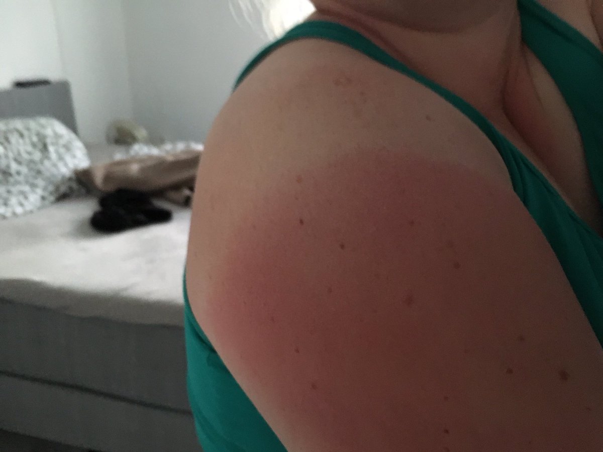 KathrinK1987's tweet photo. Weekend off, so wie descided to spend some qualitytime with Friends and Family. See the result #sunburn https://t.co/yI7rd14PHx