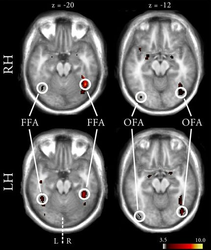 ffelisberti's tweet image. Handedness is related to neural mechanisms underlying #lateralization of face processing. nature.com/articles/srep2…