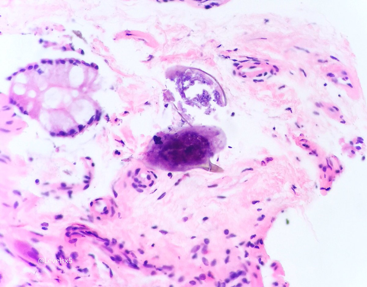Levelsx5's tweet photo. #gipath #bugpath #NotAnOrdinaryPolyp #BrownPathology https://t.co/u6pvxAsHsc