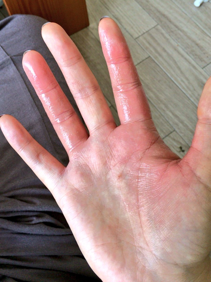 O Xrhsths ゆきこ 粒 Sto Twitter ステロイドでテッカテカだけど今朝これくらいの炎症 手のひらも痒くなってバリバリ掻いたけど水泡 はちょっとしか出てないよ 今は炎症は少し良くなってむくみと皮膚のつっぱりくらい 汗疱