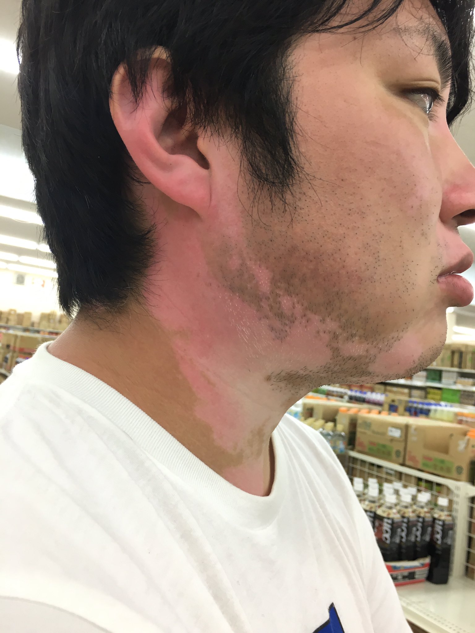 オルマン Twitterissa 白斑の俺が海で日焼けしたらこうなった 尋常性白斑