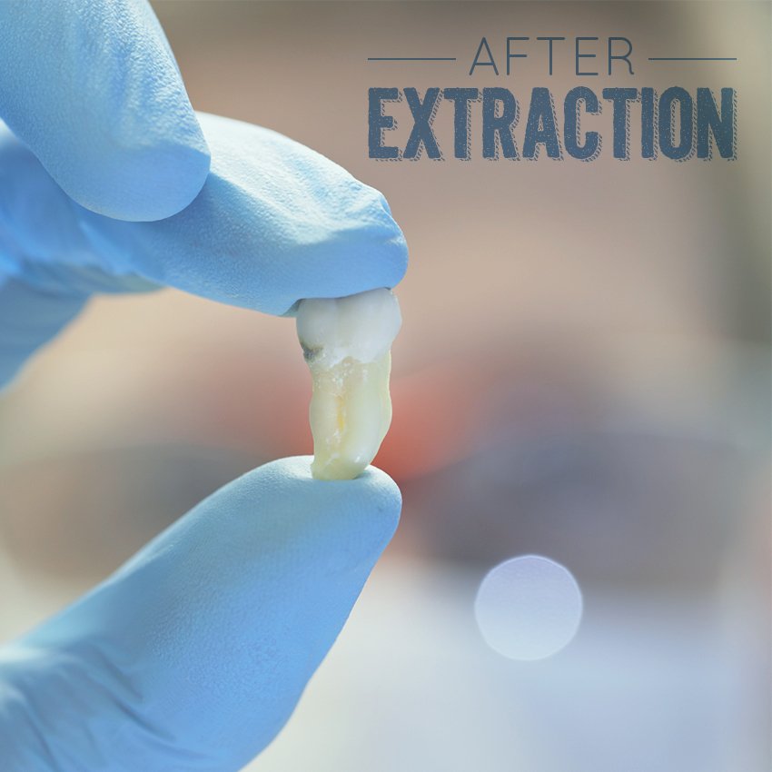 apexdocsolution's tweet image. What becomes of your extracted tooth? bit.ly/1hCNfZ7