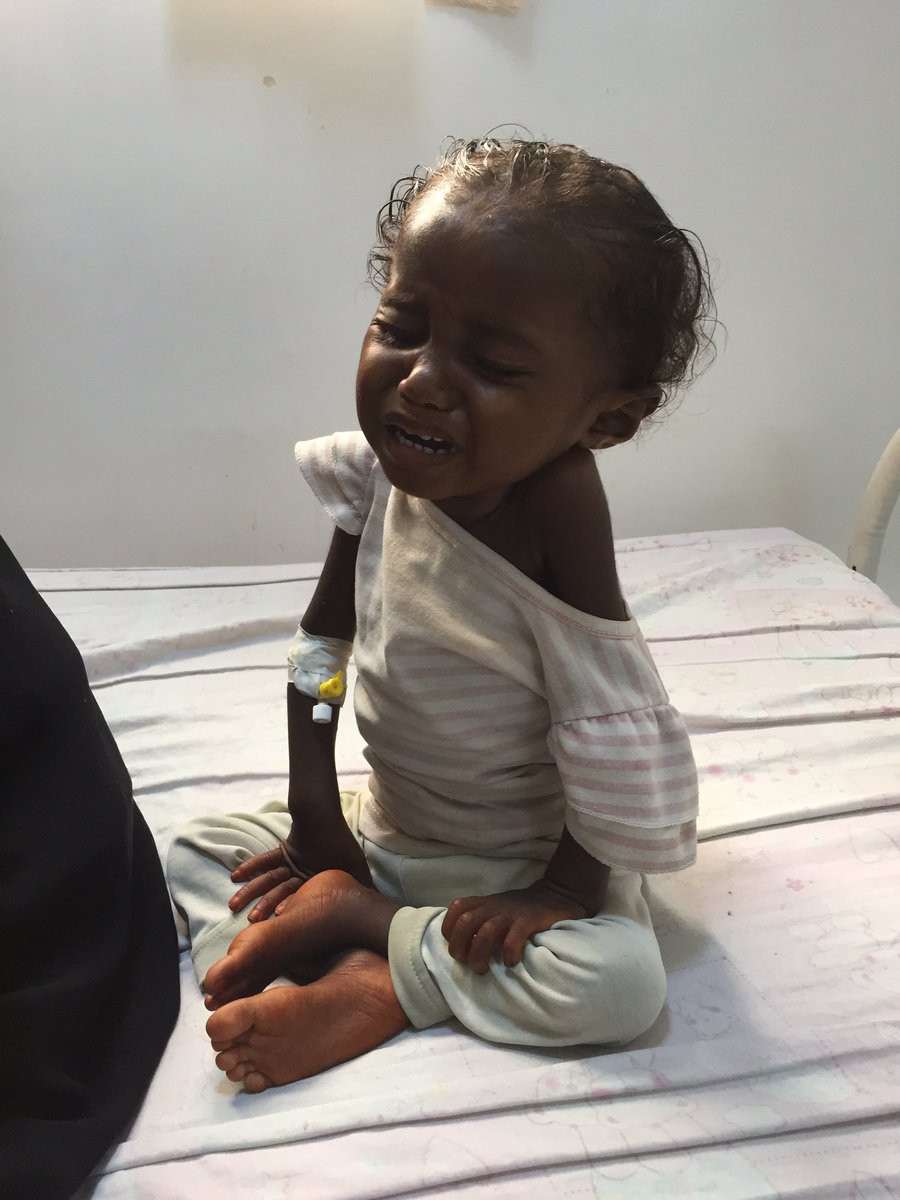krishgm's tweet image. Yemen suffering a malnutrition emergency amid war. Find out why - and what UK has to do with it - on #c4news 2moro