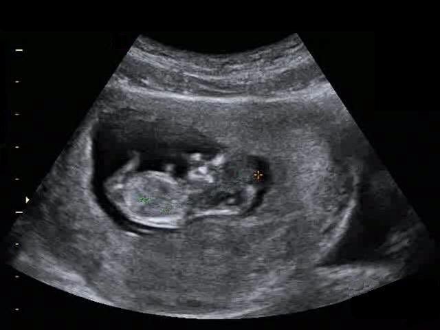 @dcddylili has the ultrasound