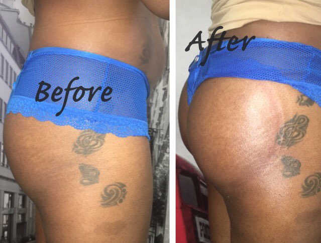 EyeMagicIntl's tweet image. Got Cakes??? Get a bigger Butt without surgery! #EyeMagicIntl #vacuumTherapy #ButtLiftAtlanta