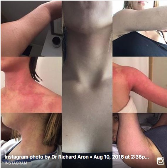etsinmods's tweet photo. TSW vs AR https://t.co/inTOWmF9sb #eczema #topicalsteroidwithdrawal #lifeaftertsw #topicalsteroids #redskinsyndrome https://t.co/1wfRSOl3eT