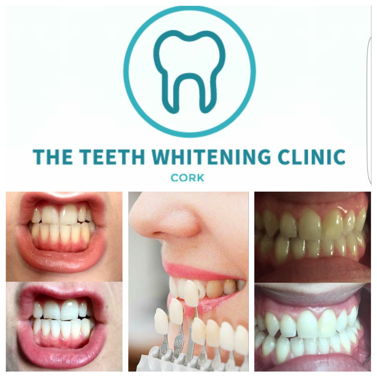 TTWCCork's tweet photo. #bestteethwhiteningcork on average our clients improved by 12-14 shades with #zerosensitivity. #cork #corkcity ❤️ https://t.co/wj3l2JgQ06