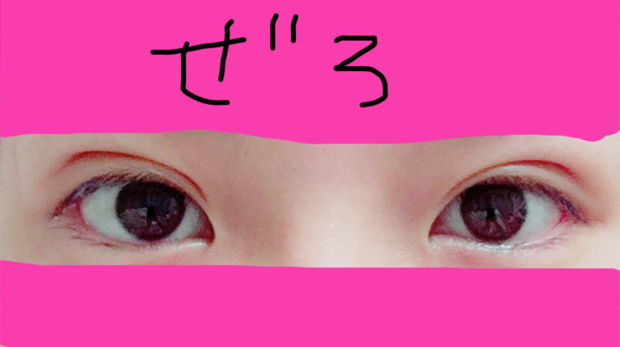 ぜろ No Twitter 埋没5日目 画像は加工済み 右目の幅広にした目尻以外は落ち着いてきました 左目の内出血のような痣 はまだ消えませんが よく見ないとわからない程度 洗顔のときに瞼を軽く触ったら少し違和感のような痛みがありました T Co Aovtpyygo5