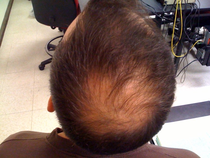 NeilSadickMD's tweet photo. Myth: If you want to reduce hair loss, stay away from gel and hairspray. Not true - No need to forgo the products. https://t.co/7ugwHHRtLZ