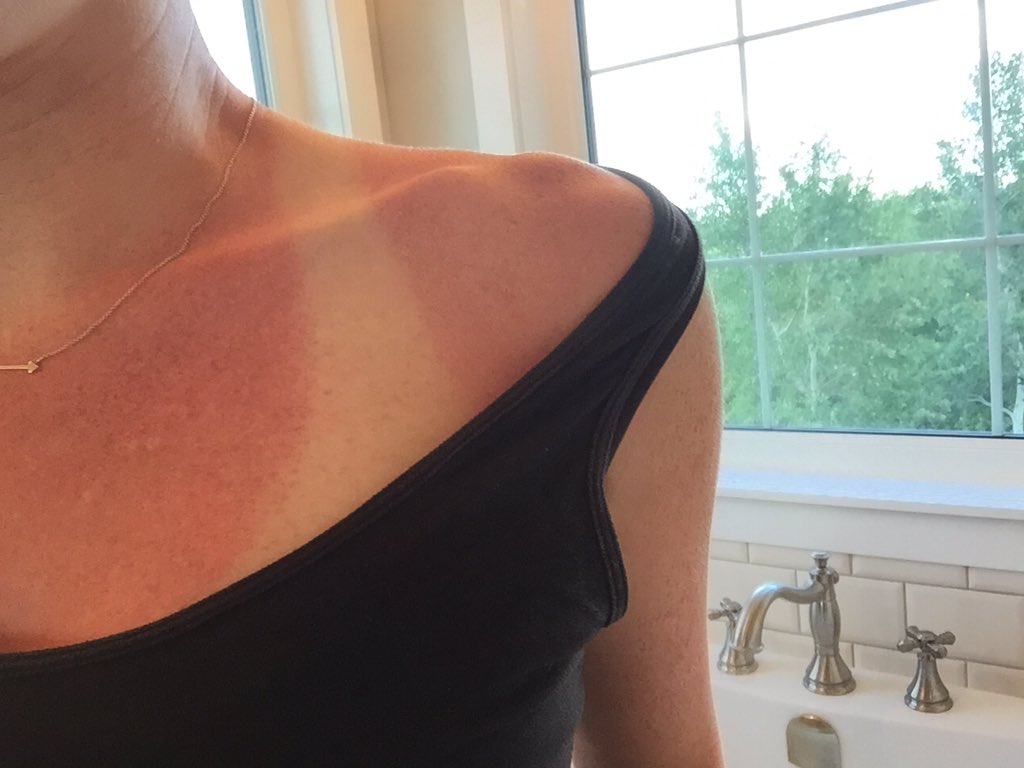 laceyteasdale's tweet image. This, folks, is why we don&apos;t use expired sunscreen #DontBeCheap #StillALittleGingy