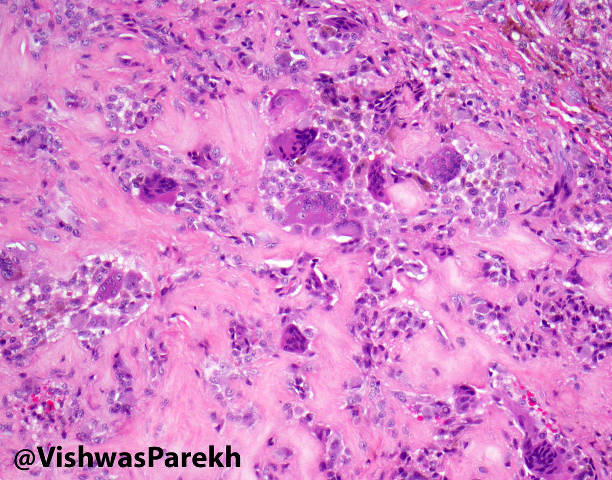 Giant Cell Tumor of Tendon Sheath AKA Localized PVNS—On digits, F&gt;M, #CSF1 overexpn #Pathology #Dearmpath #BSTPath