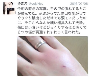猫の 本気噛み で感染 パスツレラ症の体験談が怖すぎる エキサイトニュース