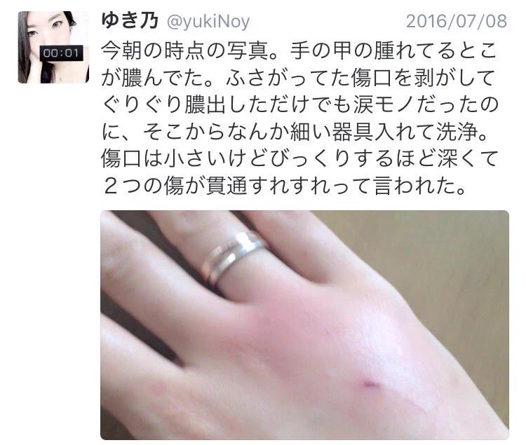 ネコを飼っている人は要注意！恐ろしすぎるパスツレラ症とは？