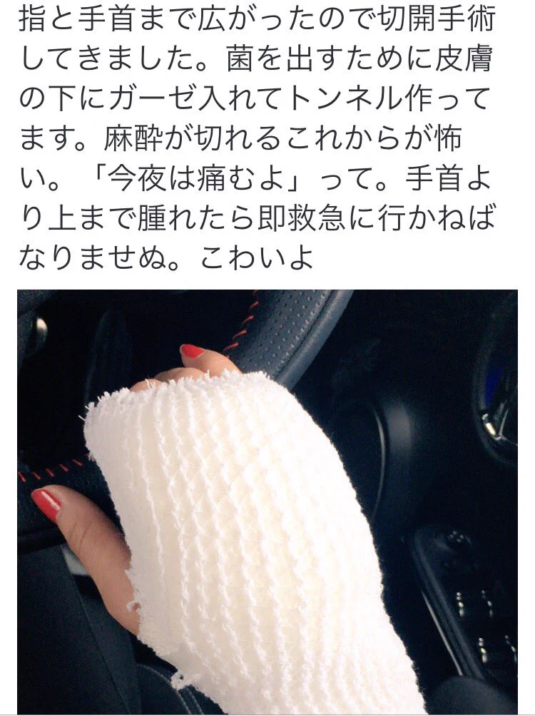実家の老猫ちゃんに本気で噛まれた結果ｗ切開手術して完治まで３週間の大参事にｗｗｗ