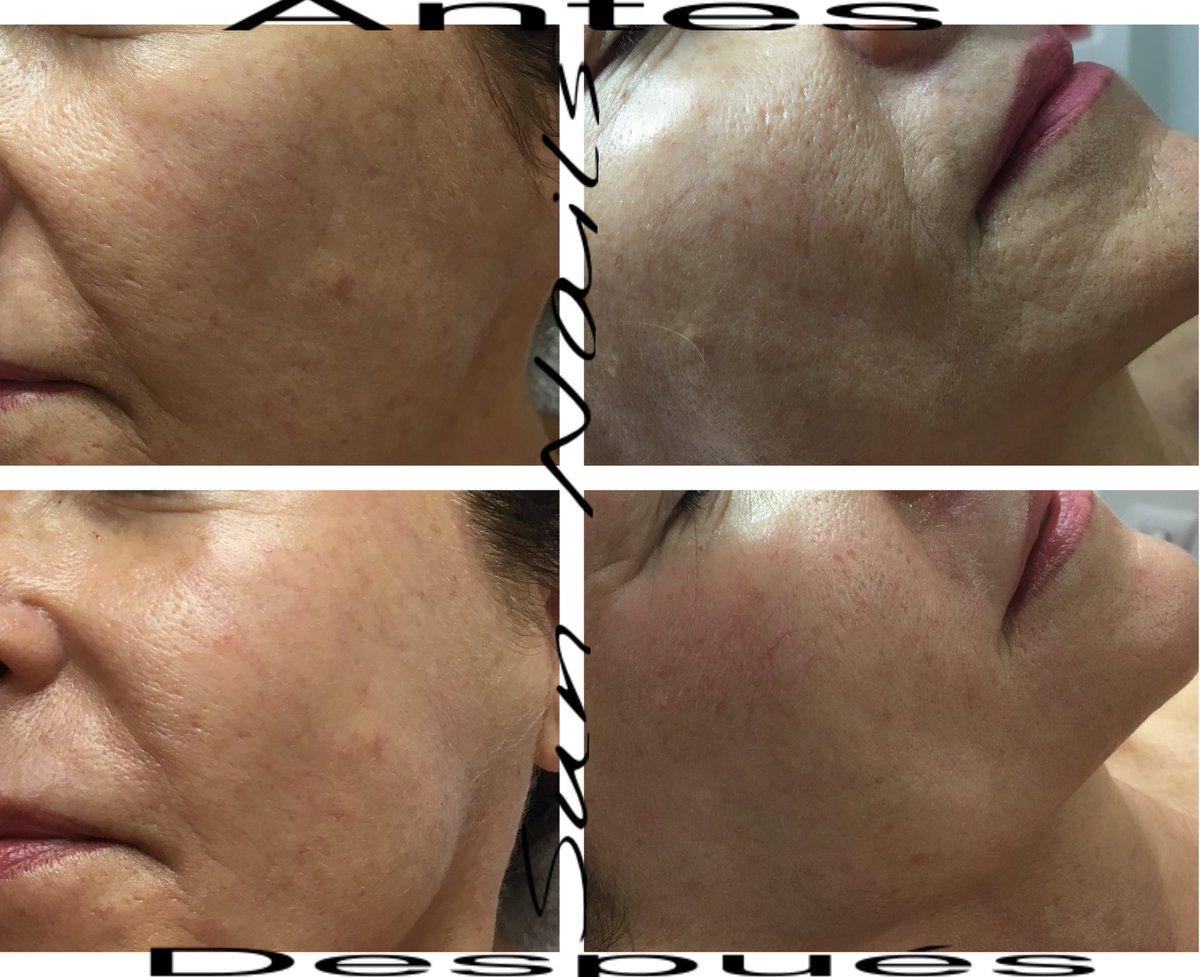 esteticSunNails's tweet photo. ¿Qué os parece?
Un antes y un después de UNA SOLA sesión de @skinfaktor #dermia https://t.co/6mhlf6xv35