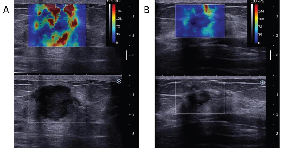 Can ultrasound elastography help guide breast cancer treatment? bit.ly/2aKh07W #radiology