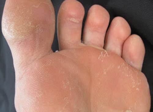 #PieDeAtleta Provoca un resquebrajamiento y dolor ubicada entre los dedos de los pies, picazón y piel en carne viva