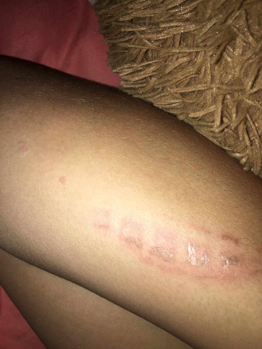 adrianderson15's tweet image. I love getting a waffle iron burn at work!! @brustersprobz @BrustersProbs #newscar #pumpedaf #fuwaffleiron