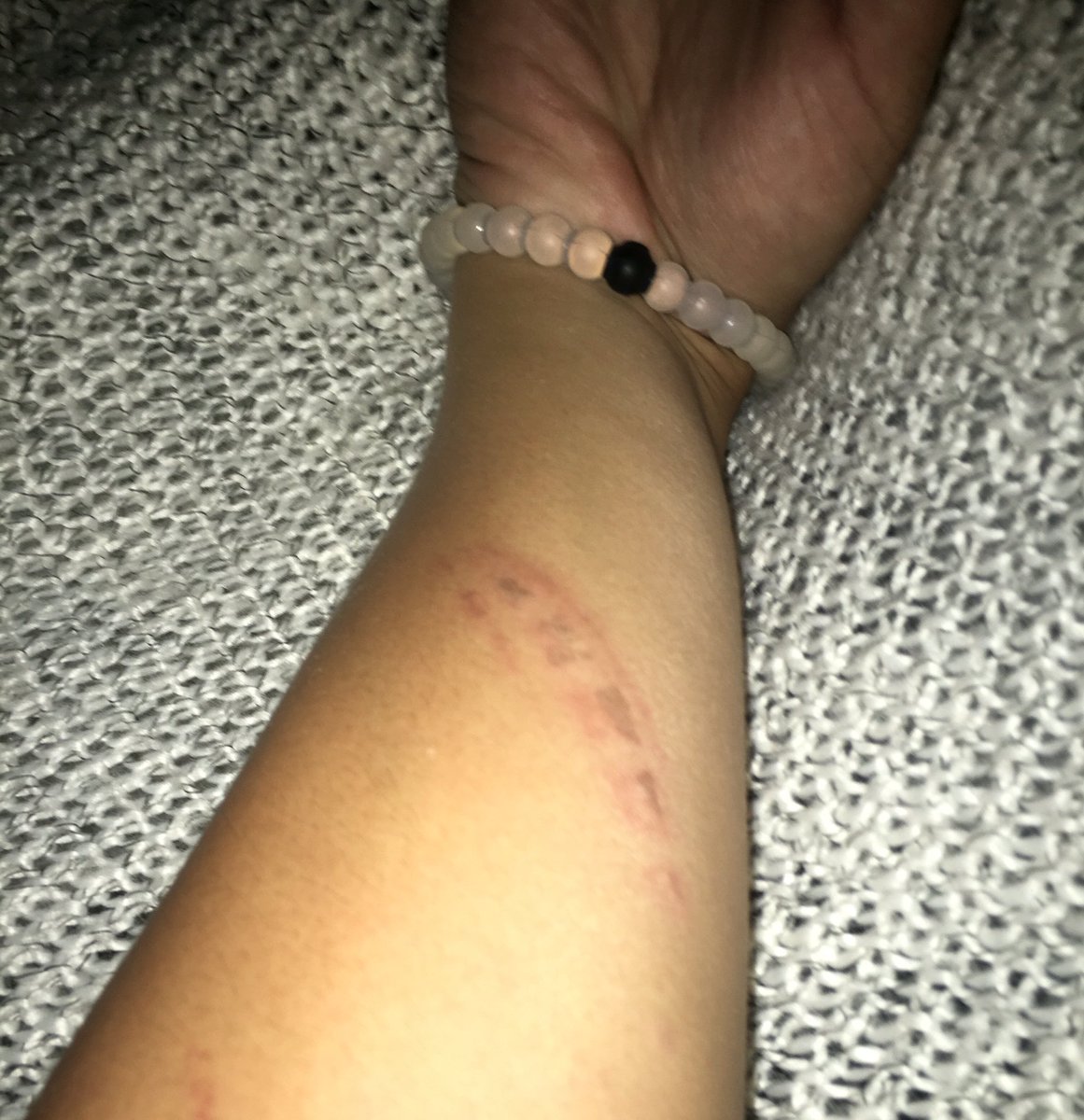 adrianderson15's tweet image. I love getting a waffle iron burn at work!! @brustersprobz @BrustersProbs #newscar #pumpedaf #fuwaffleiron