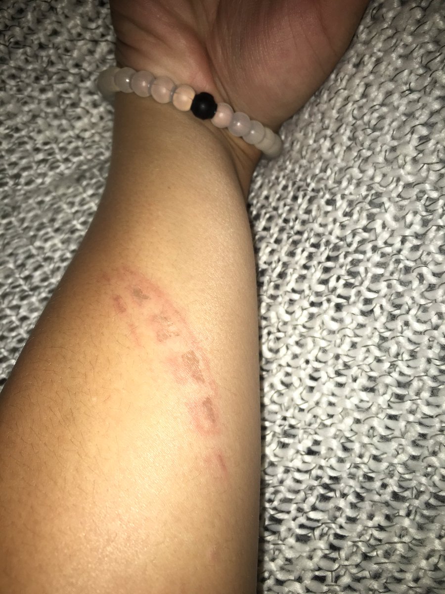 adrianderson15's tweet image. I love getting a waffle iron burn at work!! @brustersprobz @BrustersProbs #newscar #pumpedaf #fuwaffleiron