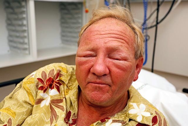 Frjóofnæmi í augum. Feeling: