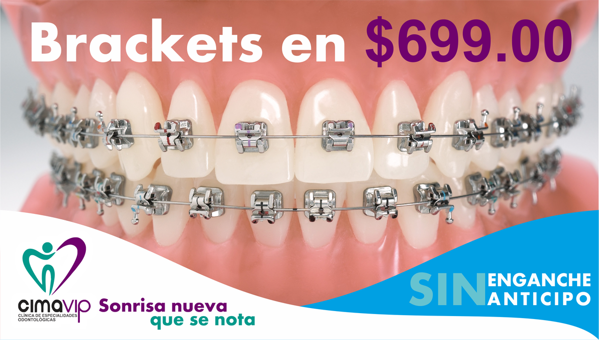 ClinicaCimaVIP's tweet photo. Brackets a solo $699.00 Metalicos y $799.00 Esteticos, #CimaVIP 3 24 68 63 , +52 1 44 34 48 15 70 o INBOX https://t.co/9X8FZZFmHL