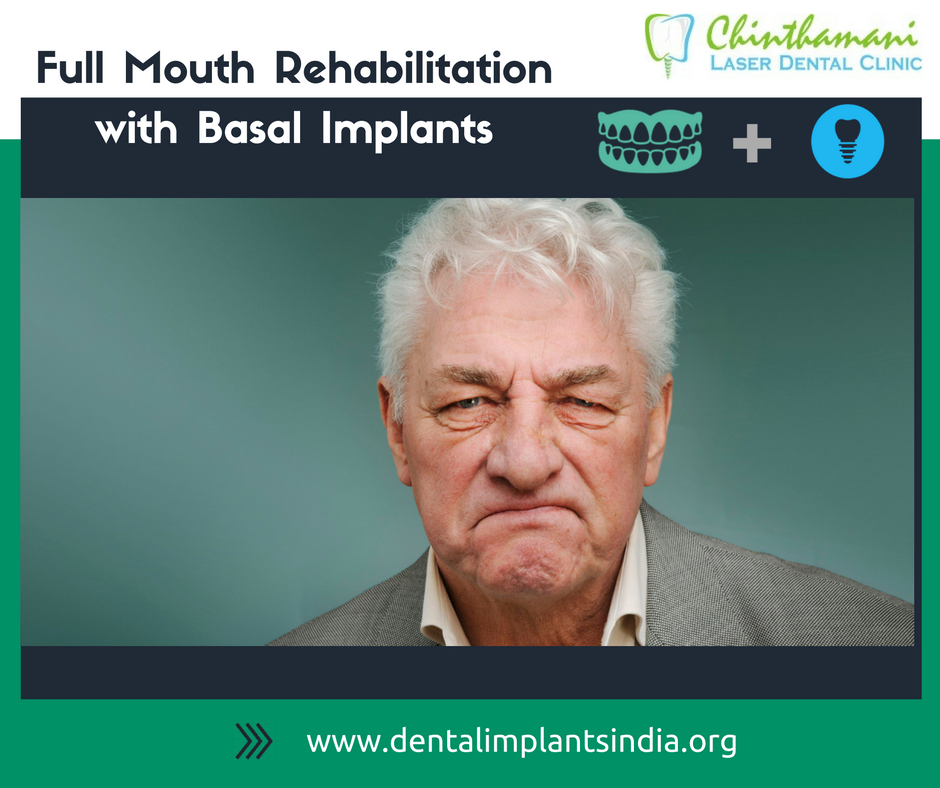 DrMurugavel's tweet image. Experience the freedom through #BasalImplants in #FullMouthRehabilitation procedure.
Visit dentalimplantsindia.org/treatments-off…