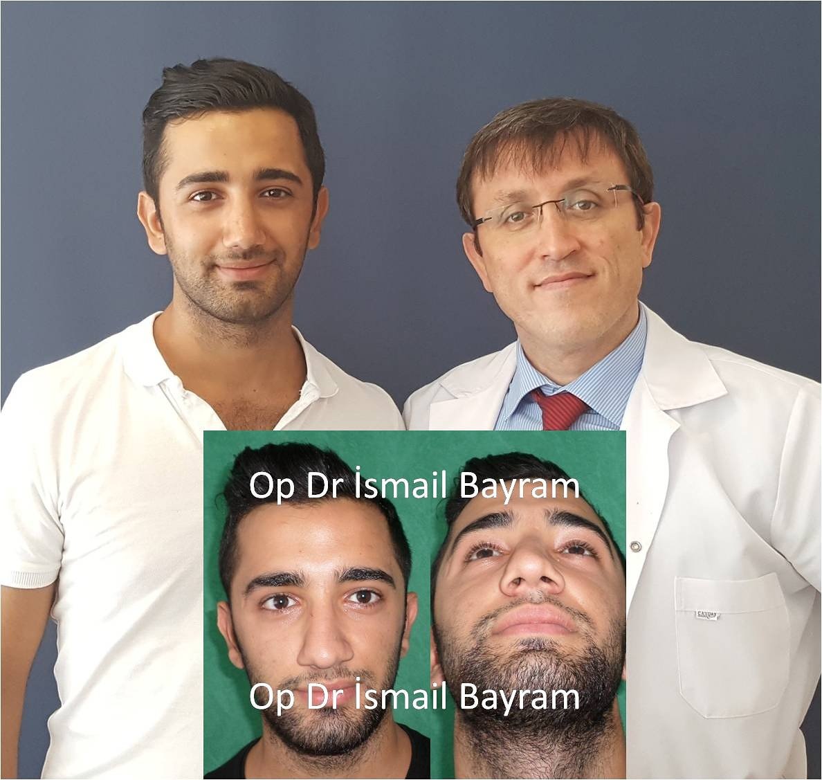 op dr ismail bayram on twitter burun